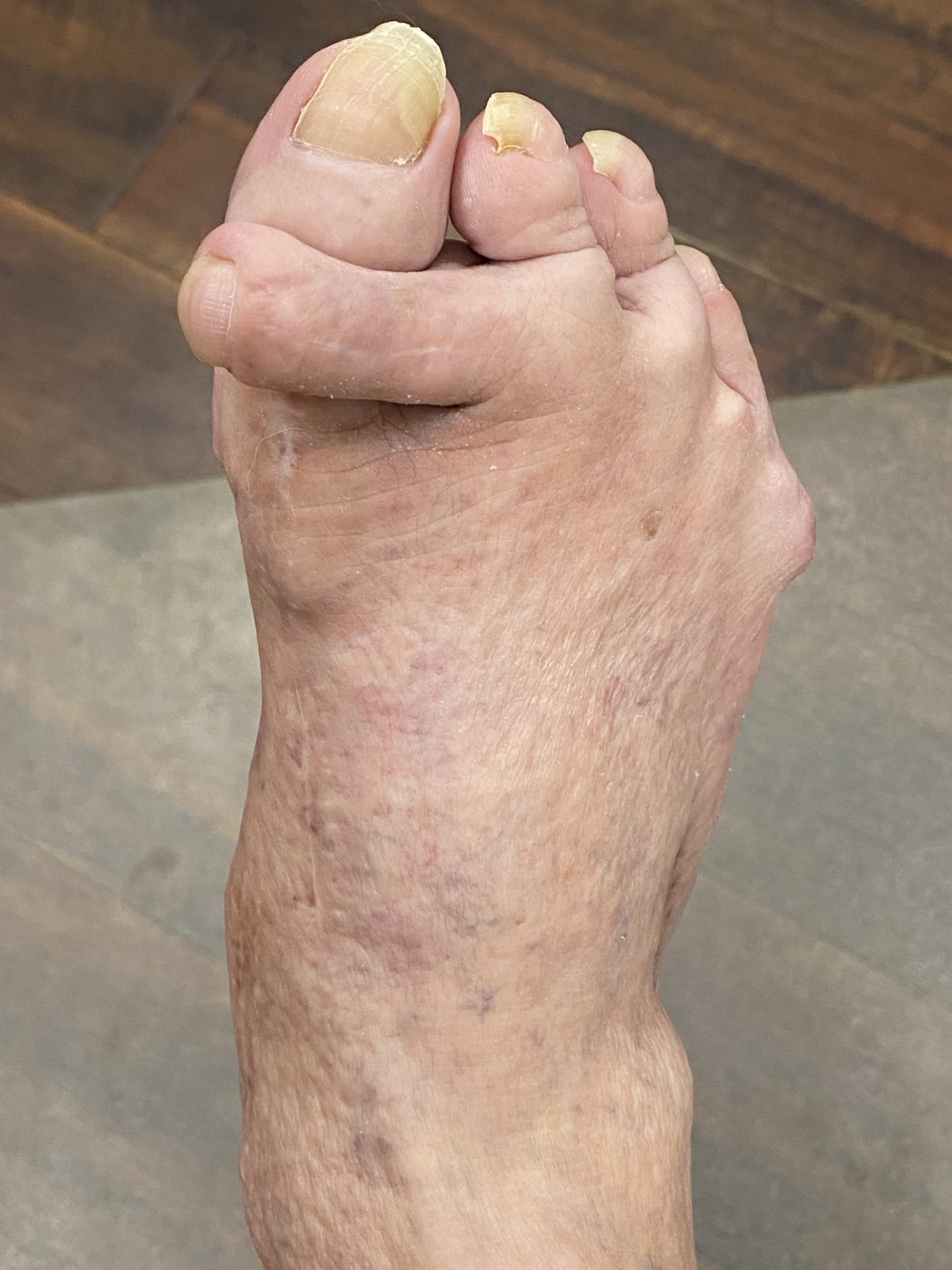 Foot Deformity – Reconstructive Foot & Ankle Institute, LLC