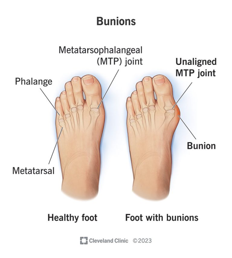 MD Podiatrist Discusses Causes of Bunions