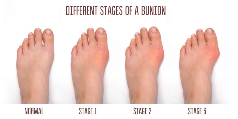 Many Patients Have Misconceptions About Bunions: MD Podiatrist