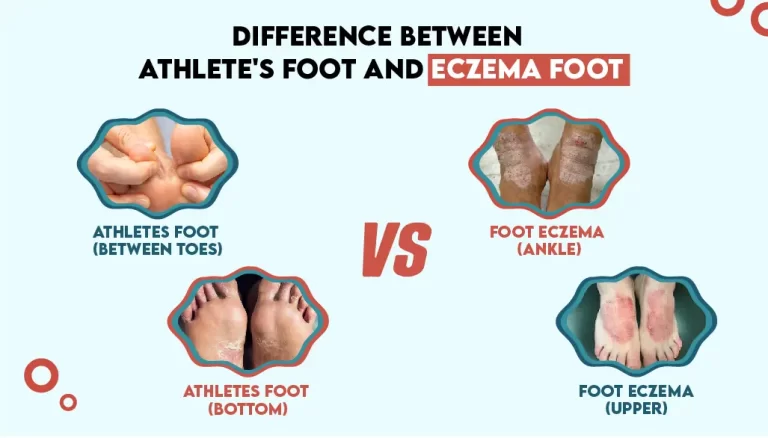 Don’t Ignore Athlete’s Foot: MD Podiatrist