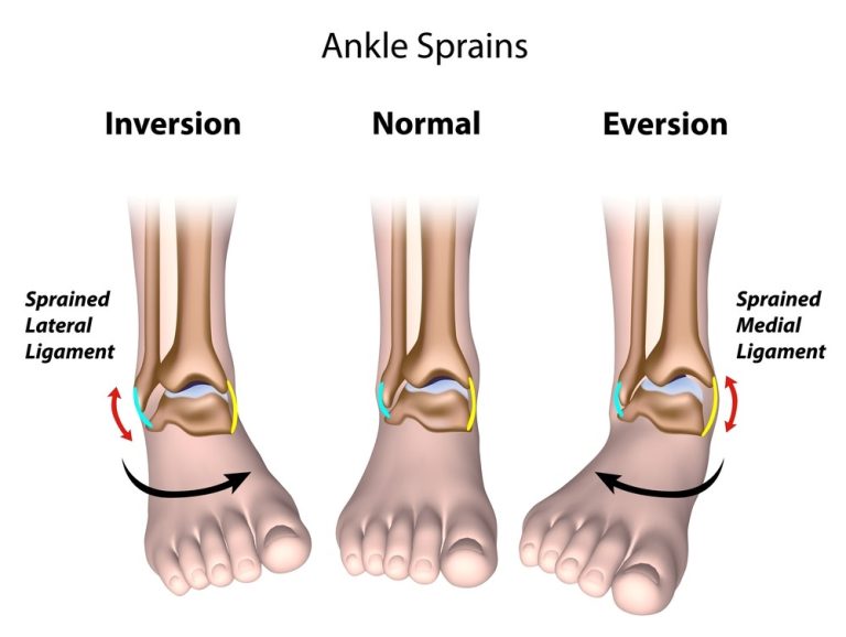 MD Podiatrist Discusses How to Prevent Recurrent Ankle Sprains