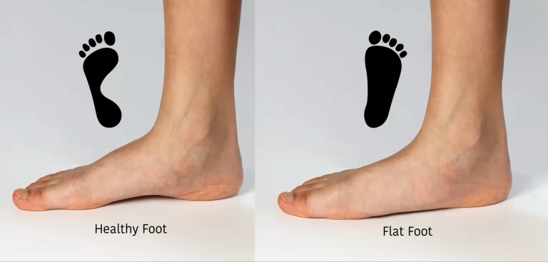 MD Podiatrist Discusses Flat Feet