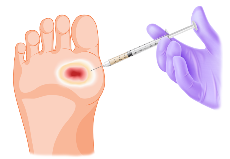 MD Podiatrist Discusses Dermal Fillers to Restore Plantar Cushion