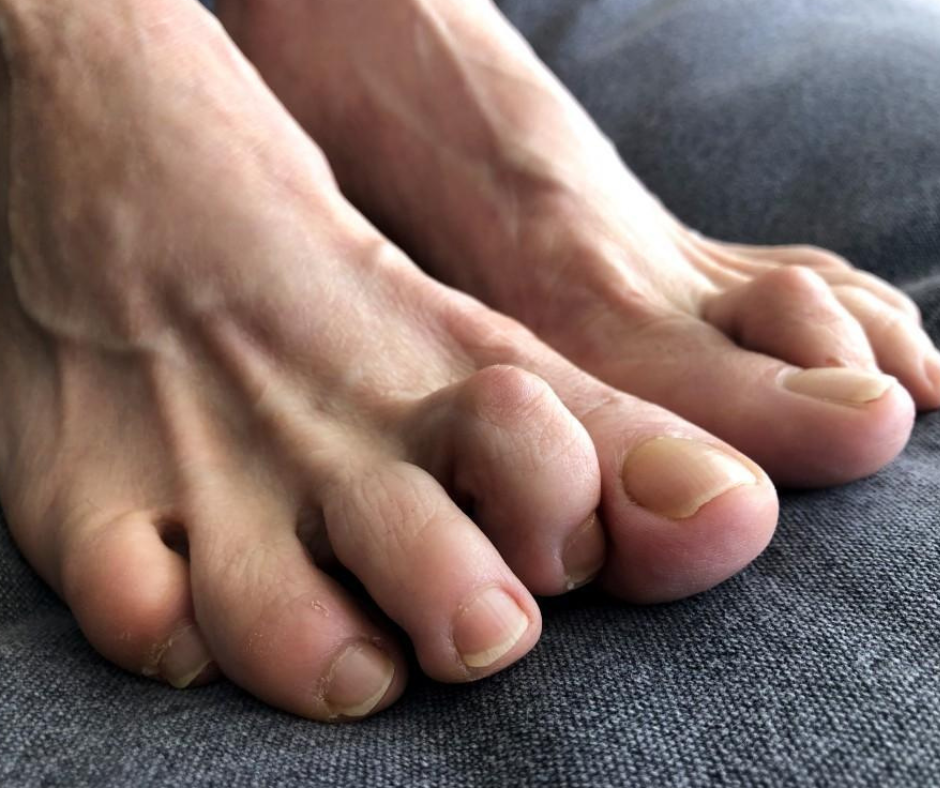 foot with hammertoe