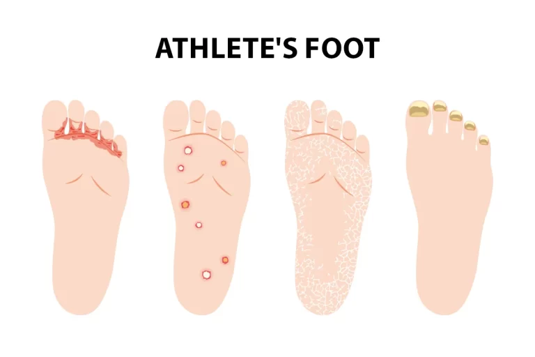 Don’t Ignore Athlete’s Foot: MD Podiatrist