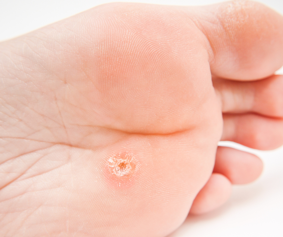 foot with callus