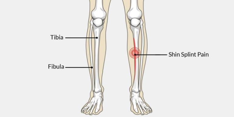 MD Podiatrist Discusses Running Shoes for Shin Splints