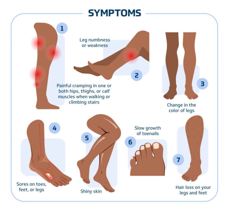 MD Podiatrist Discusses Early Signs of PAD